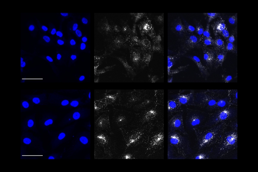 APOE 4를 가진 성상 세포도 PICALM 유전자 발현도가 높으면 이물 흡수 기능을 회복한다. 아래 열의 성상 세포(청색)는 위 열보다 트랜스페린 단백질(흰색)을 더 많이 흡수했다. (출처: MIT)