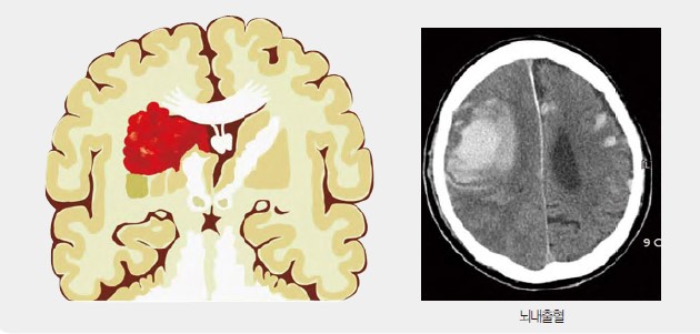 뇌졸중의 종류(뇌경색과 뇌출혈)(출처: 대구경북 권역심뇌혈관질환센터)