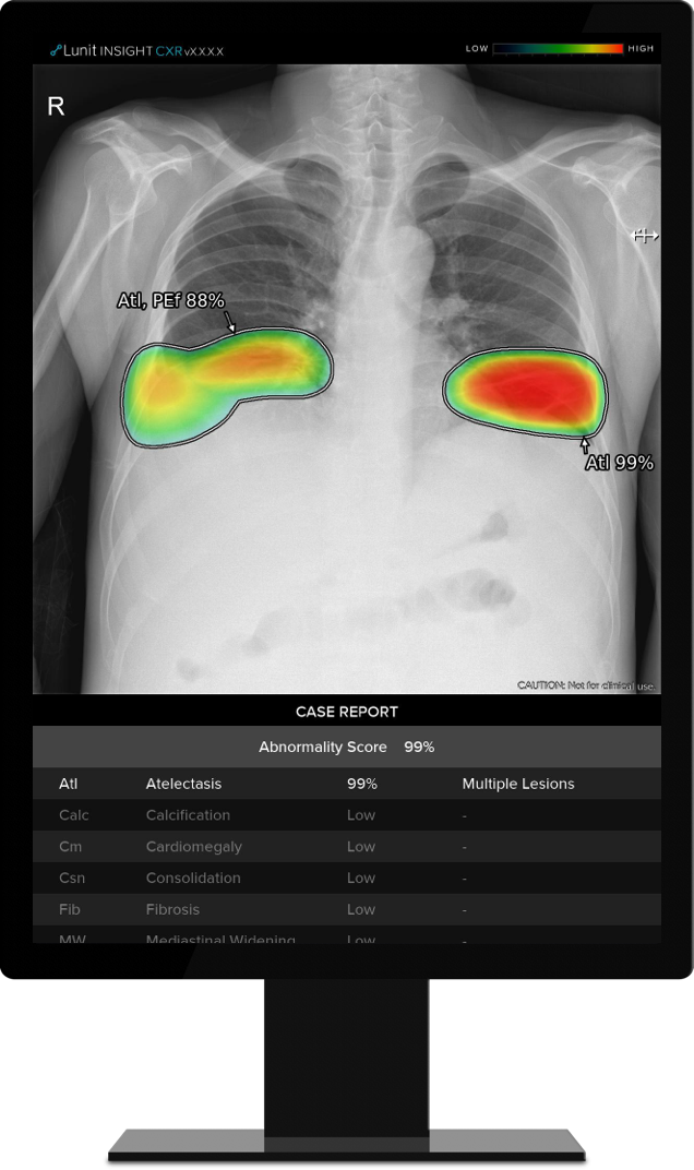 흉부 엑스레이 영상분석 AI 솔루션 '루닛 인사이트 CXR'(사진=루닛)