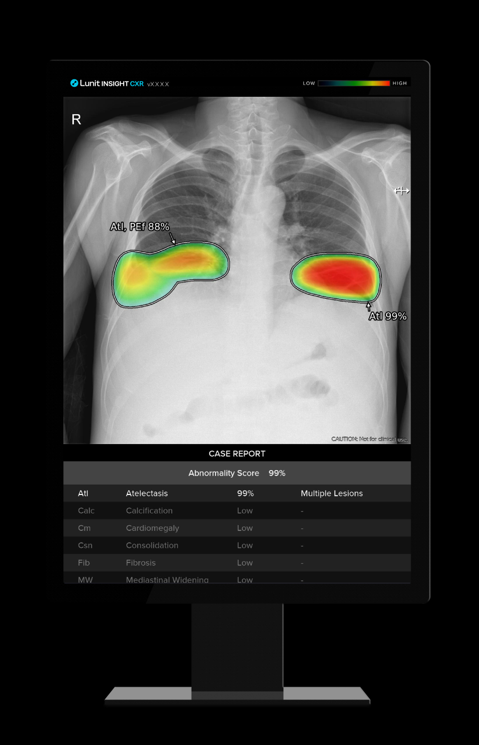 루닛의 흉부 엑스레이 AI 영상분석 솔루션 '인사이트 CXR'(사진=루닛)