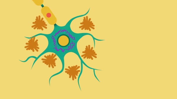알츠하이머의 발병 이유일 것으로 추정되는 plaques와 tangles (출처: Alzheimer's Association 유튜브 영상)