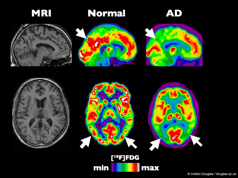 왼쪽부터 정상인과 알츠하이머병 환자의 뇌 PET 사진 (출처: Flickr)