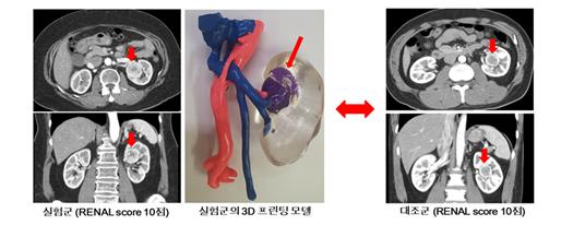 실험군(수술에 3D 프린팅 모델 활용)과 대조군의 수술 전 컴퓨터 단층촬영(CT) 사진 비교(출처: 분당서울대병원)