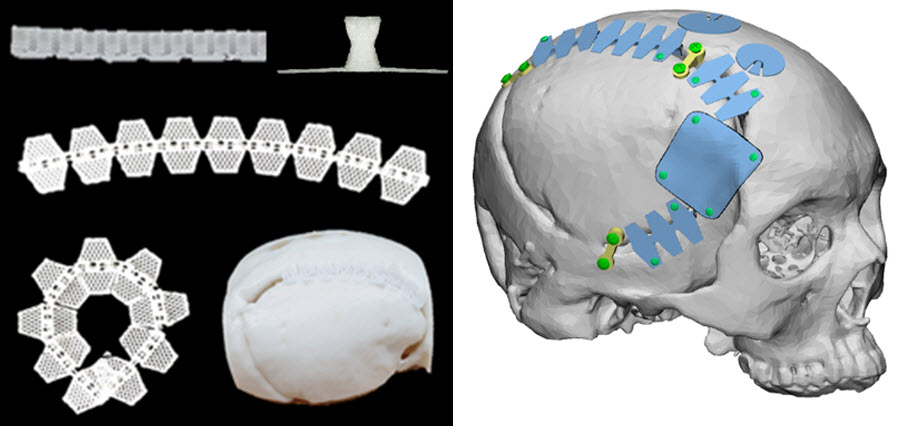 티앤알바이오팹-비브라운 신경외과 수술재료 두개안면골 임플란트 제품(좌)과 적용 예시(사진=티앤알바이오팹)